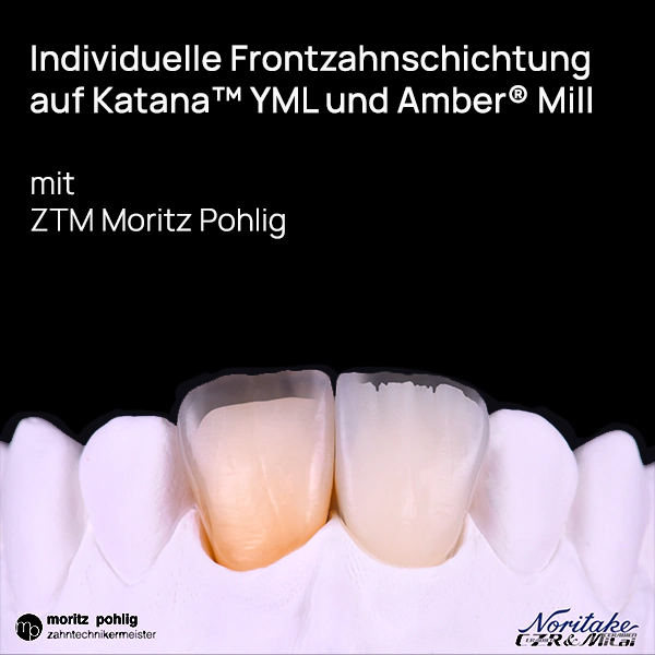 Dental-Balanace-Individuelle Frontzahnschichtung-Pohlig