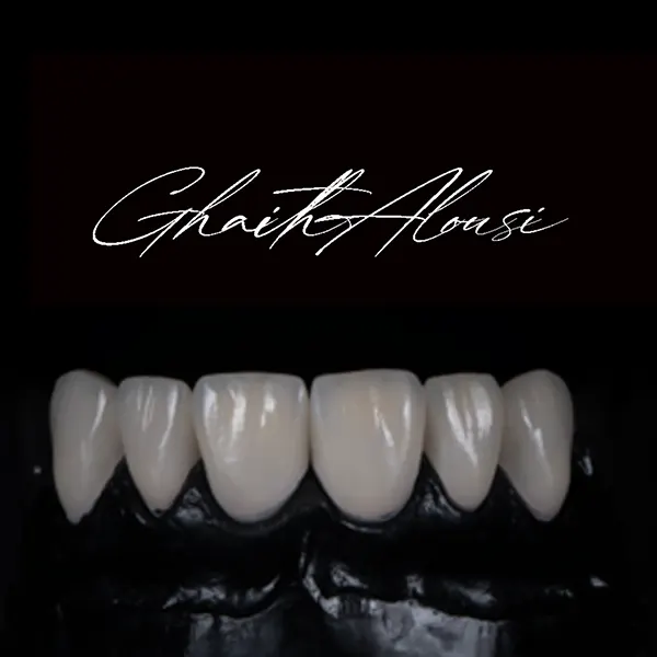 Dental-Balance-Veneers-on-Refractory